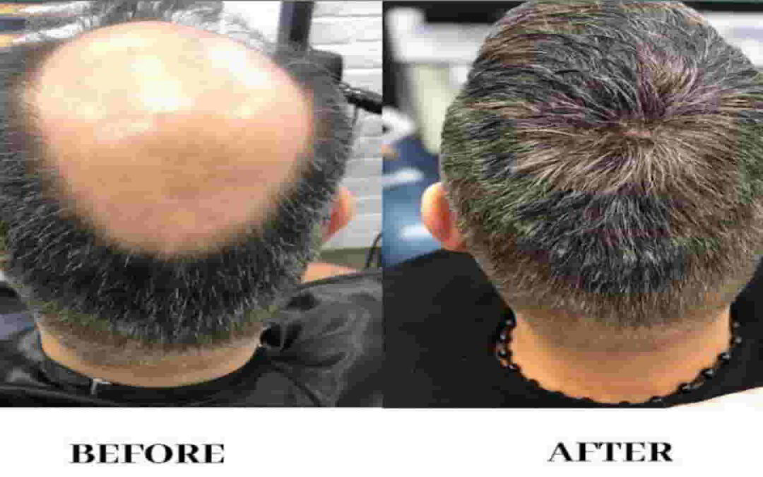 बालो का झरना हलके में न ले, जल्दी माने डॉक्टर की सलाह और करे ये उपाये-