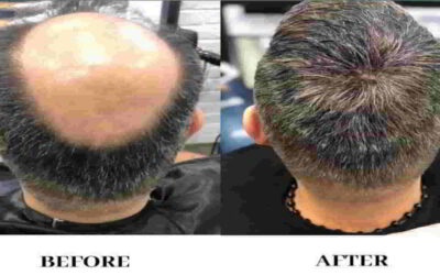 बालो का झरना हलके में न ले, जल्दी माने डॉक्टर की सलाह और करे ये उपाये-